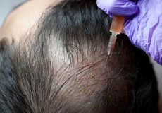 PRP and Exosomes for Hair Restoration