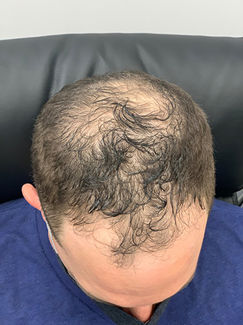 Hair Restoration