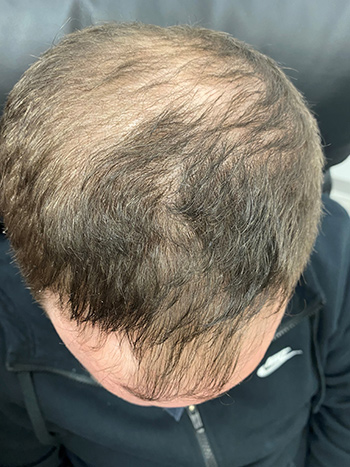 Hair Restoration