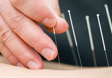 Acupuncture