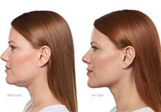 Kybella