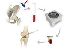 Regenerative Medicine for Sports Injuries
